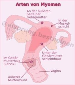 Myome und Kinderwunsch - Was tun?