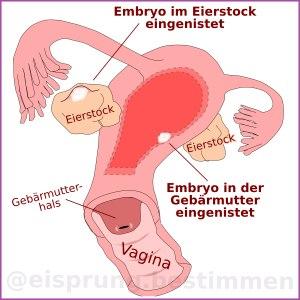 Eierstockschwangerschaft
