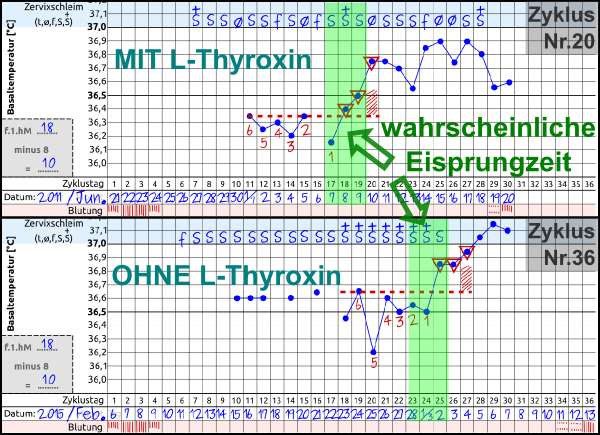 Zyklus mit Schilddrüsenunterfunktion mit und ohne L-Thyroxin